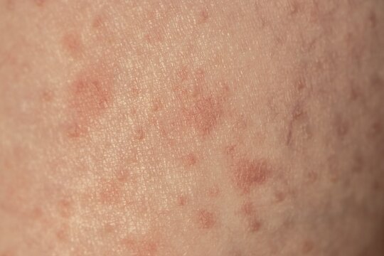 Skin with reddened spots, rash, allergy