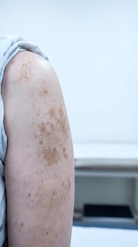 Close-up of arm showing age spots and freckles on mature skin, dermatology and skincare concept for medical education and beauty treatments.