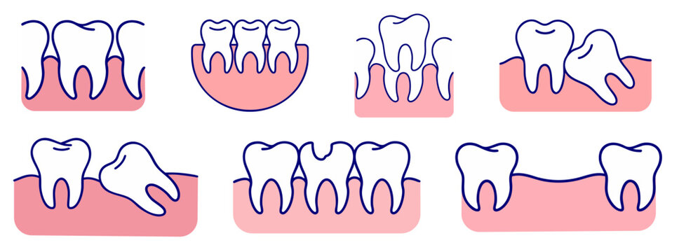 healthy teeth alignment, crowded teeth overlap, diastema gap between teeth, partially impacted wisdom tooth, horizontal impacted tooth, tooth decay and broken crown, missing tooth gap in dental row