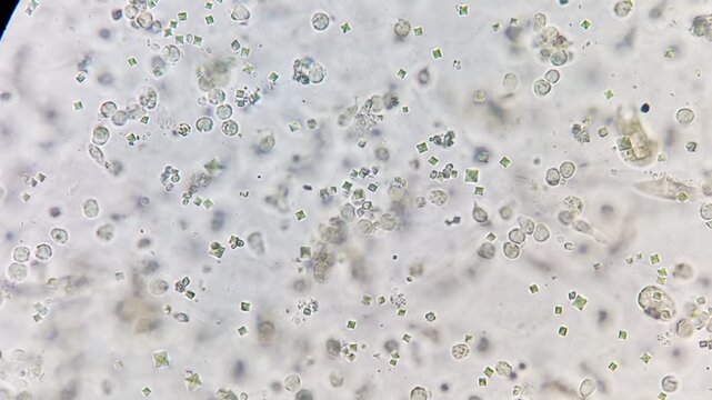 Footage of Calcium oxalate monohydrate, pus cells in urine under microscope.
