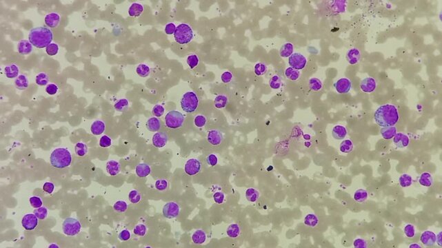Chronic Myeloid Leukemia. Features suggestive of Chronic Myeloid Leukaemia (Chronic phase). Myelocytes, band neutrophils, blast, basophils. 