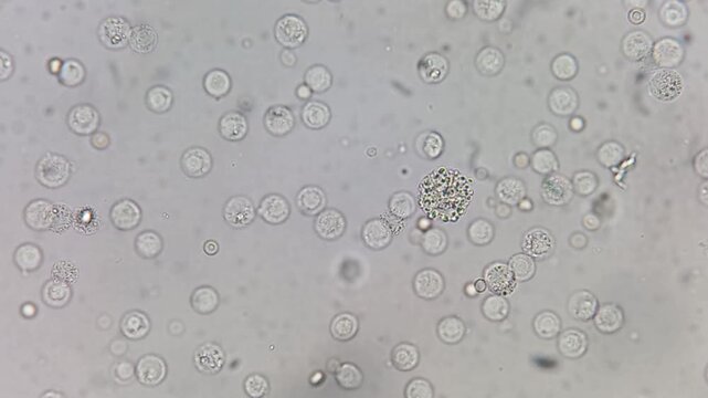 Microscopic footage of the urinalysis showing plenty Pus cells and plenty RBC.