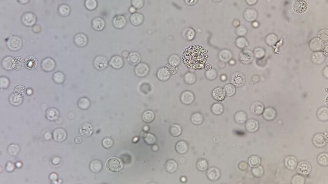 Microscopic footage of the urinalysis showing plenty Pus cells and plenty RBC.