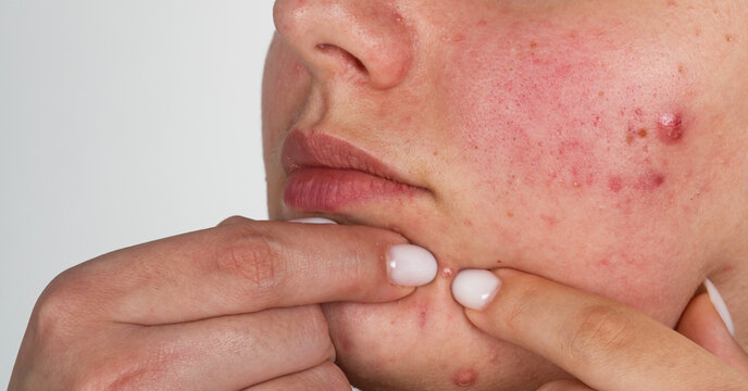 Pimple squeezing on facial skin in macro. Pimple extraction on cheek. Pimple in pores for dermatology. Pimple problem on face in closeup. Acne squeezing. Presses acne and pimples on skin with fingers.