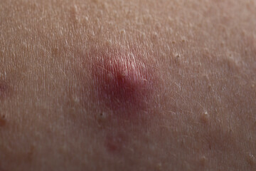 Fototapeta premium Macro shot of skin irritation with acne. Inflamed skin bumps acne macro. Detailed skin with acne. Skin rash texture with acne.