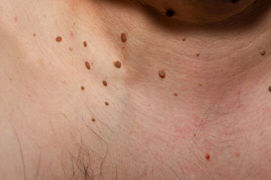 A macro shot of human skin with numerous benign neoplasms such as papillomas and nevi in the neck area. 