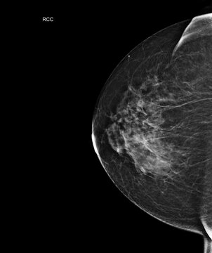 Right craniocaudal (RCC) view mammogram displaying benign fibroglandular tissue. Excellent for targeted breast cancer screening and diagnostic medical imaging.