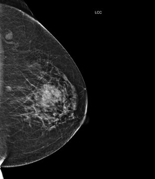 Left craniocaudal (LCC) mammogram revealing a benign cyst and normal tissue (BI-RADS 2). Great for radiology, women's health, and early detection medical themes.