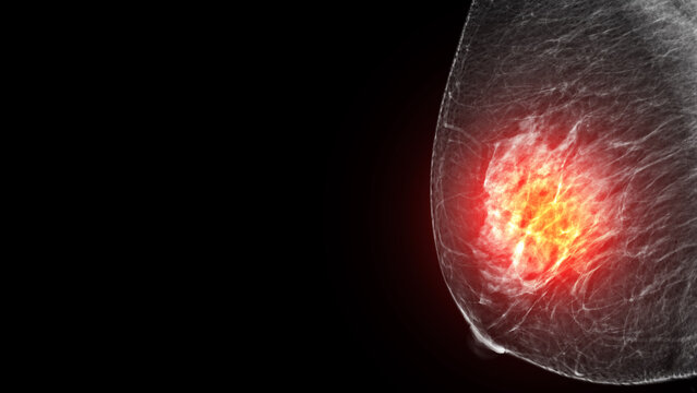Conceptual mammogram with a glowing red highlight indicating a breast tumor, cancer, or severe inflammation. Highly effective for oncology and breast cancer awareness campaigns.