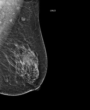  Left mediolateral oblique (LMLO) mammogram image displaying benign findings (BI-RADS 2). Ideal for clinical diagnostics, oncology, and breast cancer awareness.