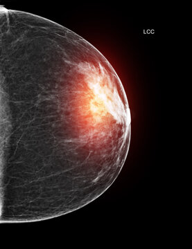 Unilateral mediolateral oblique (MLO) mammogram of the right breast showing benign findings. Medical scan for cancer screening and radiology concepts.