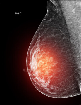  Unilateral mediolateral oblique (MLO) mammogram of the left breast showing benign findings (BI-RADS 2). Medical scan for cancer screening and women's wellness.