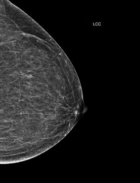 Left craniocaudal (LCC) mammogram displaying benign findings with small cysts. Perfect medical imaging for oncology, early detection, and routine health checkups.
