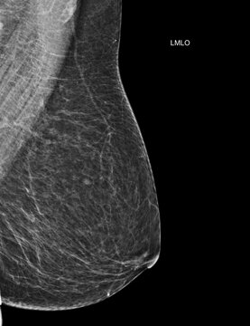 Left mediolateral oblique (LMLO) mammogram image showing a healthy screening result (BI-RADS 2). Ideal for women's wellness and breast cancer prevention campaigns.