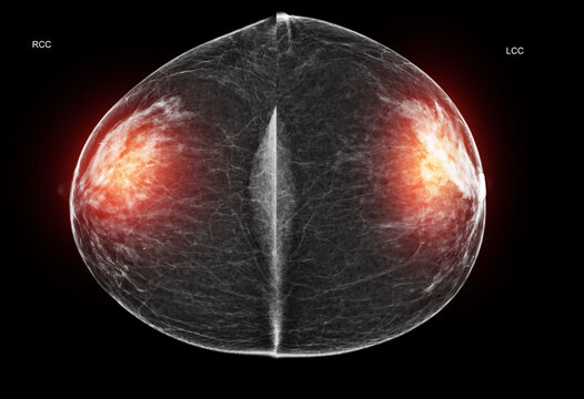 Bilateral mammogram showing Left CC (LCC) and Right CC (RCC) views side-by-side. Benign findings (BI-RADS 2) for cancer screening and medical diagnostics.