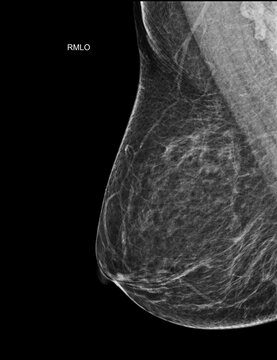 Right mediolateral oblique (RMLO) mammogram featuring normal breast tissue and benign cysts. Excellent for clinical diagnostics and preventive healthcare materials.