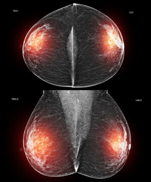 Bilateral mammogram displaying Left MLO and Right MLO views side-by-side showing benign findings (BI-RADS 2). Medical imaging for cancer screening and women wellness.