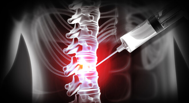 Medical 3D illustration of an anatomical human spine showing disc degeneration and a targeted epidural steroid injection for pain relief.
