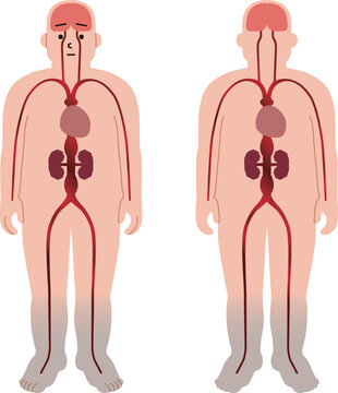 血管障害などによる疾患。動脈瘤や心臓、腎臓の病気のイラスト。