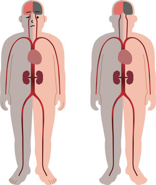 血管障害などによる疾患。半身麻痺や脳、心臓、腎臓の病気のイラスト。