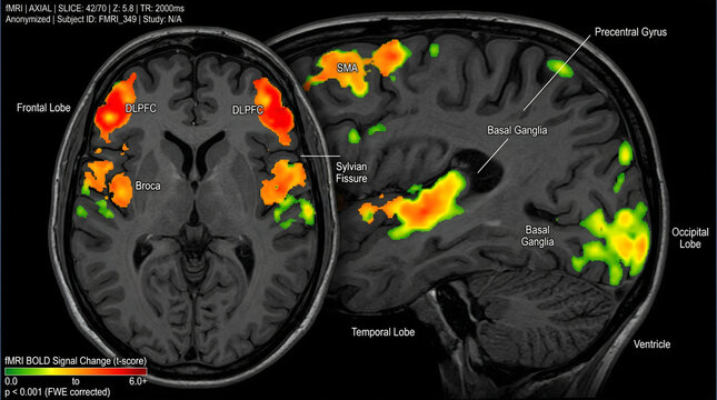 A medical scan of a brain with highlighted areas of activity and labeled sections