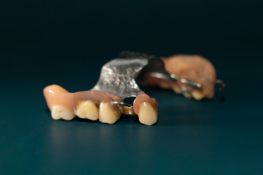 Removable partial denture with artificial teeth and metal base on dark green background. Studio macro photography isolated object. Dentistry and oral healthcare concept. Design for poster, banner.