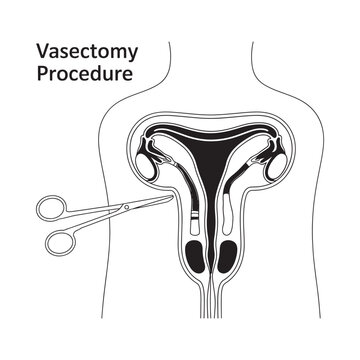 Medical illustration depicting a vasectomy procedure on the male reproductive system