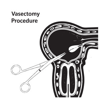 Diagram illustrating a vasectomy procedure on male reproductive anatomy