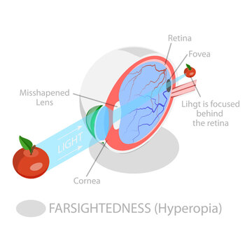 3D Isometric Flat Vector Illustration of Vision Disorder, Far-Sightedness And Near-Sightedness Anatomical Diagram. Item 2