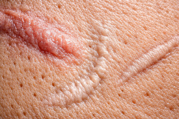 Fototapeta premium Macro detail of keloid scar on human skin, cicatrix from an injury. Dermatology concept showing healing process, skin texture, and surface imperfection of body