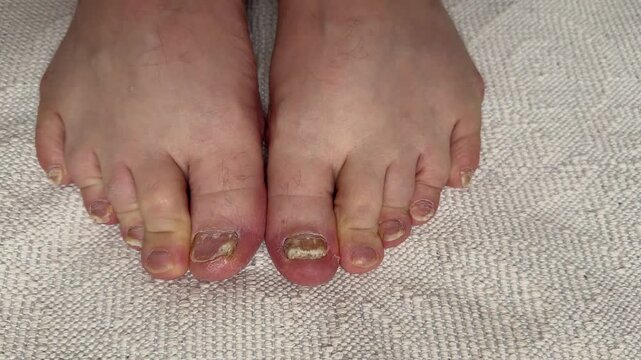 Onychomycosis. Dangerous fungal infection of human toenails on a white background at the doctor. Disease and detachment of the nail plate. Close-up.