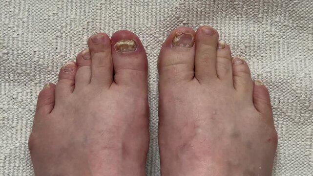 Onychomycosis of toenails by a patient. A dangerous fungal infection of toenails in a person. Disease and detachment of the nail plate. Regular cleaning and inspection.