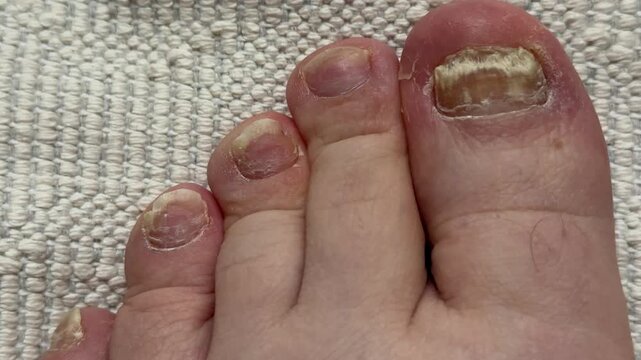 Toenail fungal infection closeup showing yellowed crumbling big toenail and surrounding toes on white carpet.