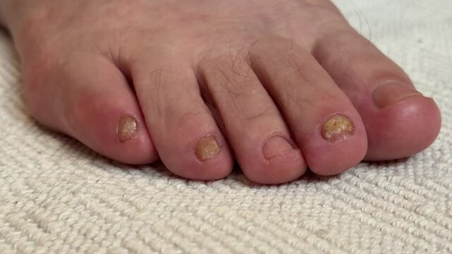 Onychomycosis of toenails by a patient. A dangerous fungal infection of toenails in a person. Disease and detachment of the nail plate. Regular cleaning and inspection.