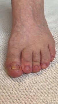 Onychomycosis of toenails by a patient. A dangerous fungal infection of toenails in a person. Disease and detachment of the nail plate. Regular cleaning and inspection.
