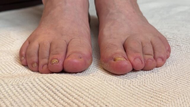 Onychomycosis of toenails by a patient. A dangerous fungal infection of toenails in a person. Disease and detachment of the nail plate. Regular cleaning and inspection.