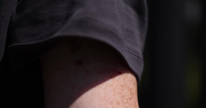   hand of a person with a large bruise , the details of the hand and the bruise on the arm where the bruise has a different color and irregular shape