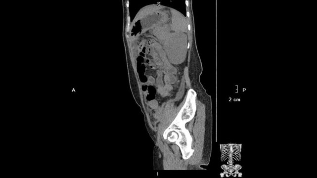 Abdominal CT imaging demonstrates large bilateral solid ovarian masses, predominantly on the right, causing mass effect with anterior displacement of the urinary bladder, superior bowel compression