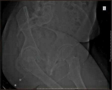 Hysterosalpingography (HSG) X-ray showing uterine cavity and fallopian tubes with contrast injection. Used to evaluate tubal patency and infertility. Original radiology image, not AI generated