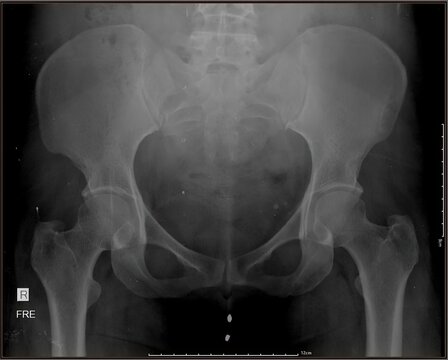 Hysterosalpingography (HSG) X-ray showing uterine cavity and fallopian tubes with contrast injection. Used to evaluate tubal patency and infertility. Original radiology image, not AI generated