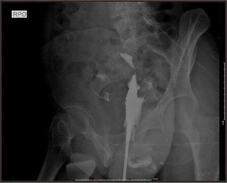 Hysterosalpingography (HSG) X-ray showing uterine cavity and fallopian tubes with contrast injection. Used to evaluate tubal patency and infertility. Original radiology image, not AI generated