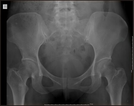 Hysterosalpingography (HSG) X-ray showing uterine cavity and fallopian tubes with contrast injection. Used to evaluate tubal patency and infertility. Original radiology image, not AI generated
