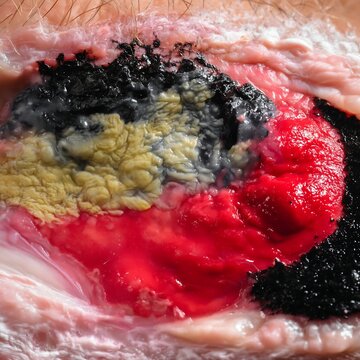 Debridement Wound Care Healing Stages with Necrotic Tissue Removal