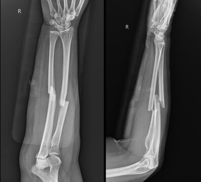Medical X-ray of Forearm Showing Both Bone Fracture of Radius and Ulna with Displacement.