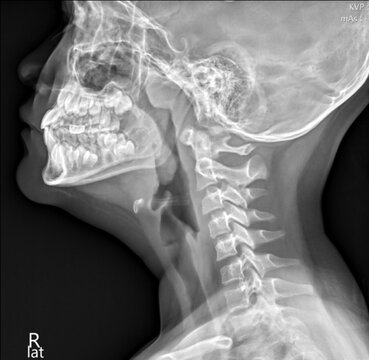 Lateral Neck X-ray Showing Adenoid Hypertrophy and Nasopharyngeal Airway Obstruction in Pediatric Patient.
