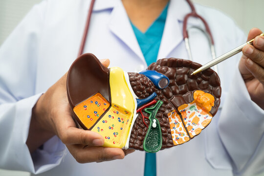 Cirrhosis, Liver cancer, fatty liver, Asian woman with liver human anatomy model.