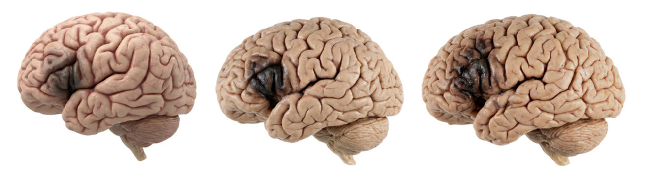 Human brain stroke (AVC) medical anatomy set isolated on transparent background, realistic 3D illustration of cerebral infarction showing damaged area in four views. 