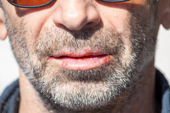 portrait of man with beard with herpes. Close-up of a man's face with a herpes simplex virus infection, cold sores on the lower and upper lips. Herpes simplex-Virus concept. concept of Sun avoidance