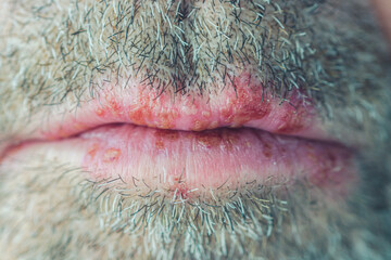 Obraz premium man with beard. Close-up of a unshaved man's face with a herpes simplex virus infection, cold sores on the lower and upper lips. Herpes simplex-Virus concept