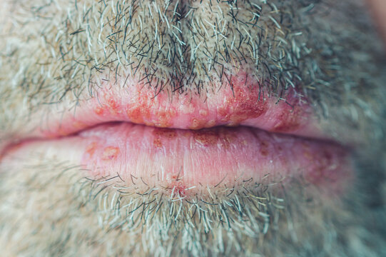 man with beard. Close-up of a unshaved man's face with a herpes simplex virus infection, cold sores on the lower and upper lips. Herpes simplex-Virus concept